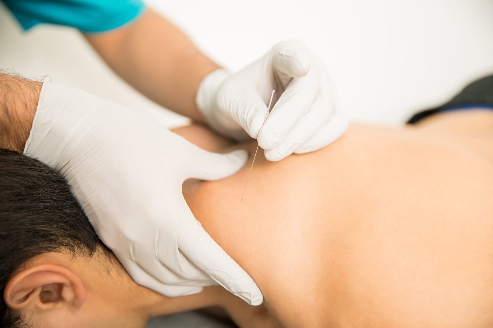 Applying Dry Needling