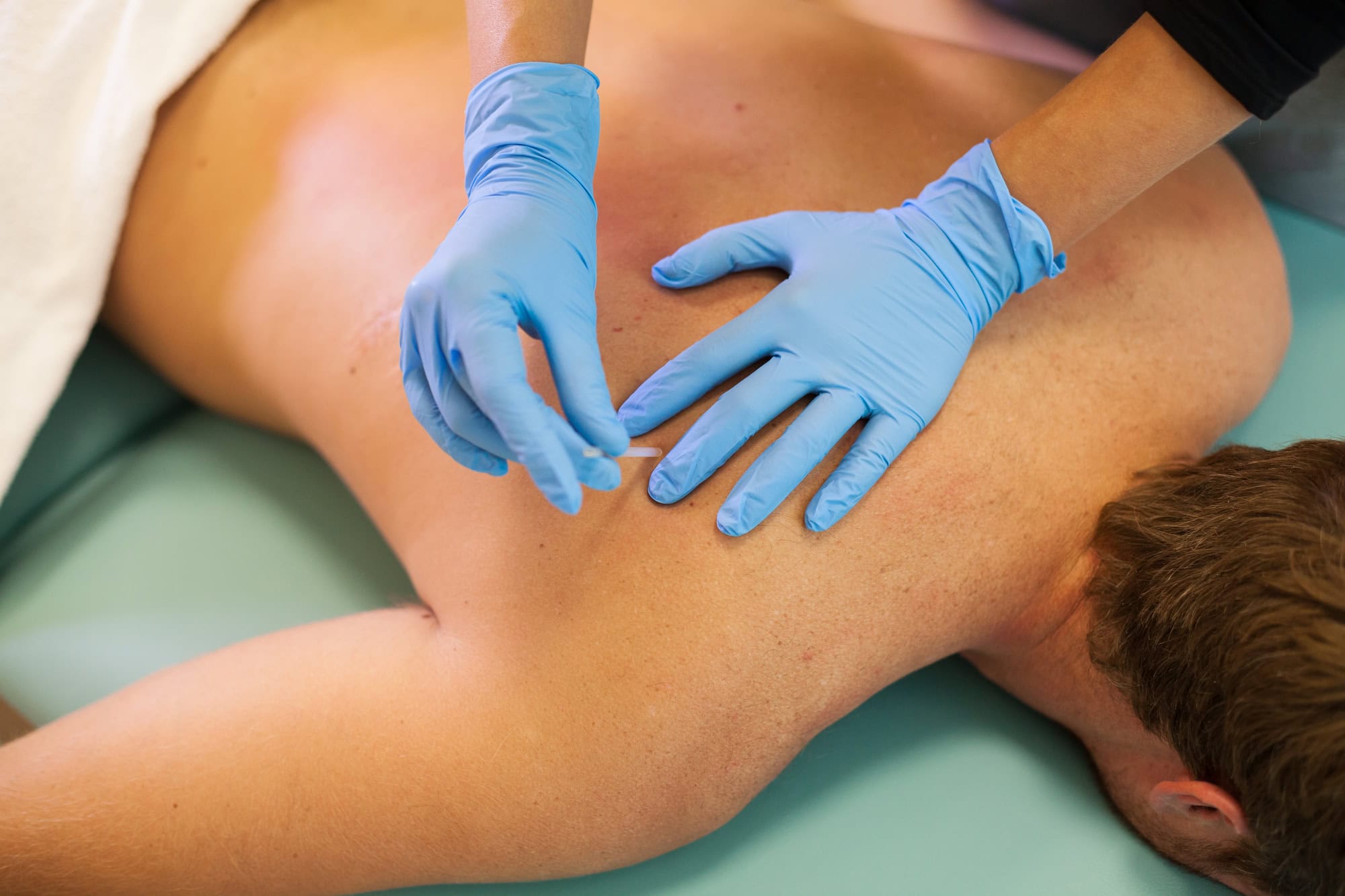 Dry Needling Application