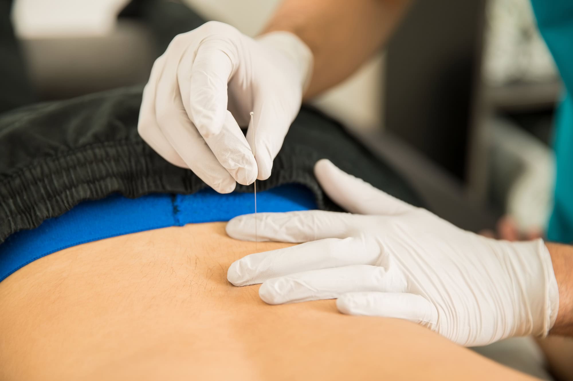 Focus shot on applying dry needling